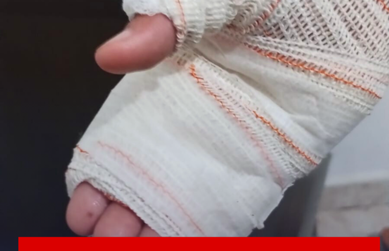 Comerciante é acusado de fritar a mão de menino autista na chapa de lanche em Ibaté