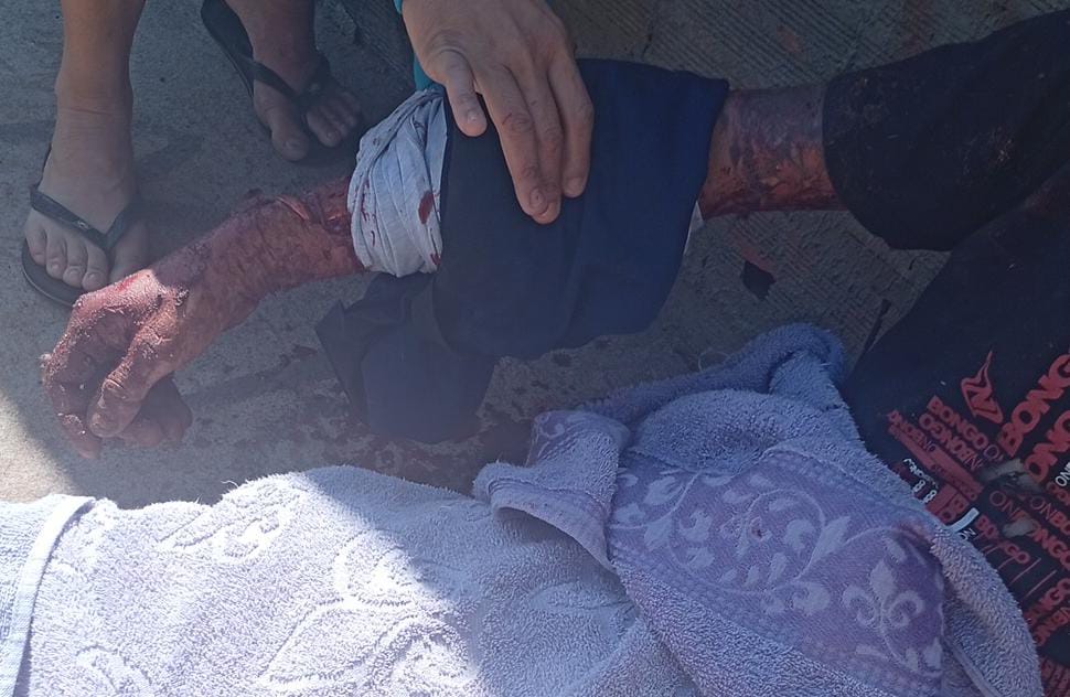 Homem é atacado por dois pitbulls e sofre graves ferimentos após pular muro de residência no Jardim Cruzado