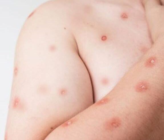 Ribeirão Preto confirma dois casos de mpox em 2026