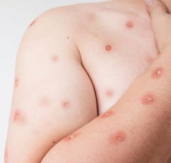 Ribeirão Preto confirma dois casos de mpox em 2026