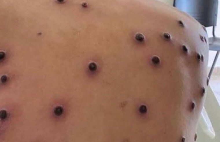 🚨Araraquara registra primeiro caso de Mpox confirmado pelo Estado