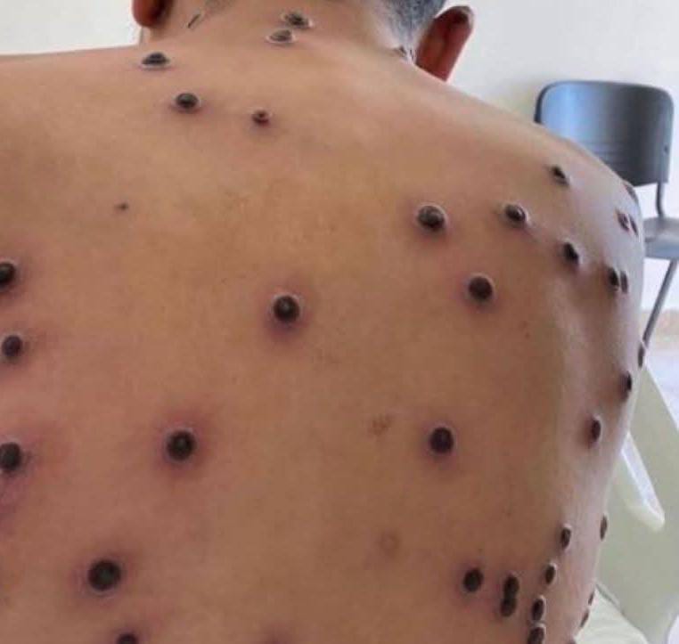 🚨Araraquara registra primeiro caso de Mpox confirmado pelo Estado