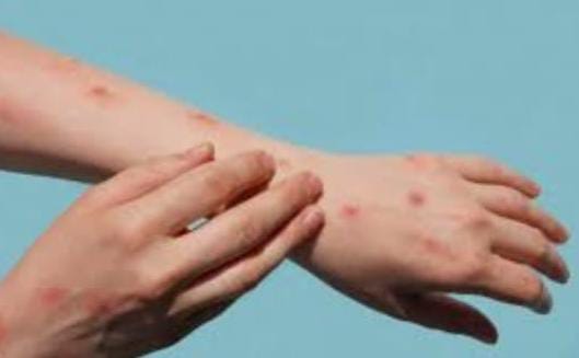 🚨Criança de 9 anos é investigada como possível segundo caso de Mpox em Araraquara